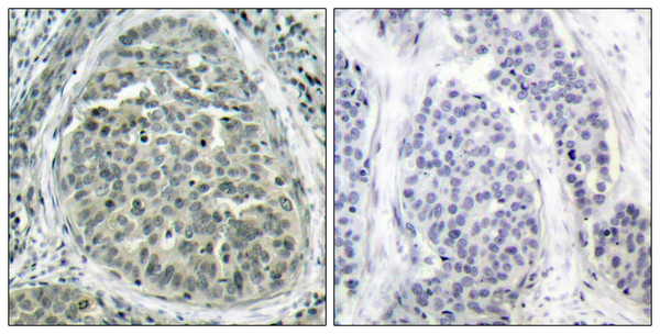 Immunohistochemistry analysis of paraffin-embedded human breast carcinoma, using Catenin-beta (Phospho-Ser37) Antibody. The picture on the right is blocked with the phospho peptide.