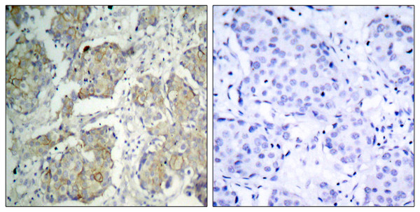 Immunohistochemistry analysis of paraffin-embedded human breast carcinoma, using VEGFR2 (Phospho-Tyr1214) Antibody. The picture on the right is blocked with the phospho peptide.