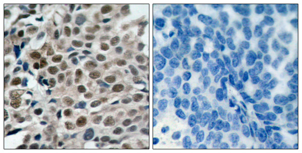Immunohistochemistry analysis of paraffin-embedded human breast carcinoma, using FKHRL1 (Phospho-Ser253) Antibody. The picture on the right is blocked with the phospho peptide.