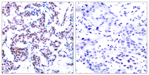 Immunohistochemistry analysis of paraffin-embedded human breast carcinoma, using JunB (Phospho-Ser259) Antibody. The picture on the right is blocked with the phospho peptide.
