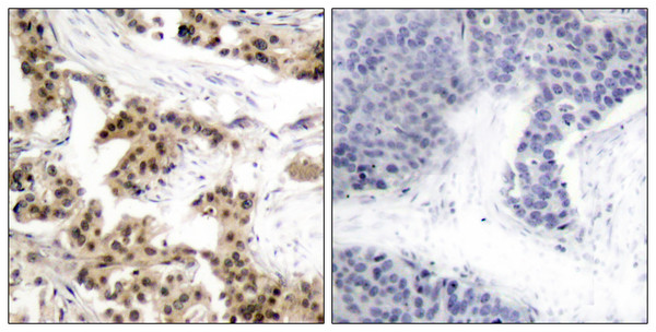 Immunohistochemistry analysis of paraffin-embedded human breast carcinoma, using NF-kappaB p105/p50 (Phospho-Ser893) Antibody. The picture on the right is blocked with the phospho peptide.
