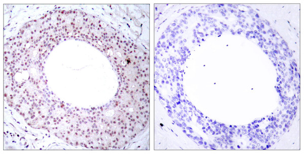 Immunohistochemistry analysis of paraffin-embedded human breast carcinoma, using NF-kappaB p65 (Phospho-Thr254) Antibody. The picture on the right is blocked with the phospho peptide. Immunohistochemistry analysis of paraffin-embedded human breast carcinoma, using NF-kappaB p65 (Phospho-Thr254) Antibody. The picture on the right is blocked with the phospho peptide.
