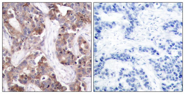 Immunohistochemistry analysis of paraffin-embedded human breast carcinoma, using Stathmin 1 (Phospho-Ser24) Antibody. The picture on the right is blocked with the phospho peptide.