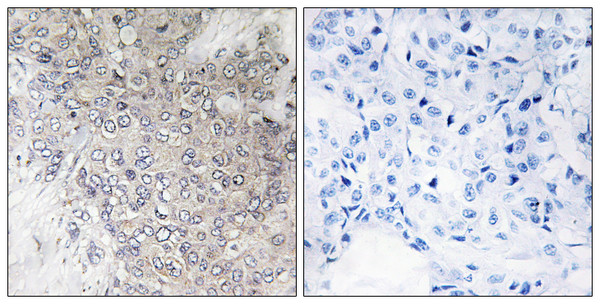Immunohistochemistry analysis of paraffin-embedded human breast carcinoma, using p70 S6 Kinase (Phospho-Thr421) Antibody. The picture on the right is blocked with the phospho peptide.