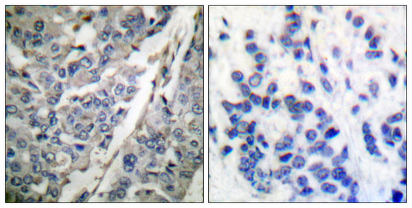 Immunohistochemistry analysis of paraffin-embedded human breast carcinoma, using Synaptotagmin (Phospho-Thr202) Antibody. The picture on the right is blocked with the phospho peptide. Immunohistochemistry analysis of paraffin-embedded human breast carcinoma, using Synaptotagmin (Phospho-Thr202) Antibody. The picture on the right is blocked with the phospho peptide.