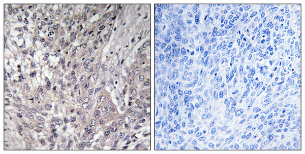 Immunohistochemistry analysis of paraffin-embedded human breast cancer, using VASP (Phospho-Ser157) Antibody. The picture on the right is blocked with the VASP (Phospho-Ser157) peptide.