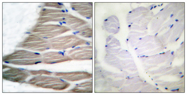 Immunohistochemistry analysis of paraffin-embedded human breast carcinoma, using ACC1 (Phospho-Ser80) Antibody. The picture on the right is blocked with the phospho peptide.