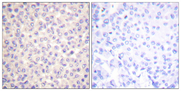 Immunohistochemistry analysis of paraffin-embedded human breast carcinoma, using FADD (Phospho-Ser194) Antibody. The picture on the right is blocked with the phospho peptide.