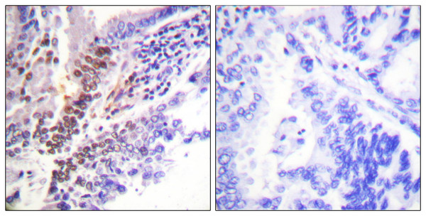 Immunohistochemistry analysis of paraffin-embedded human lung carcinoma, using GR (Phospho-Ser226) Antibody. The picture on the right is blocked with the phospho peptide.