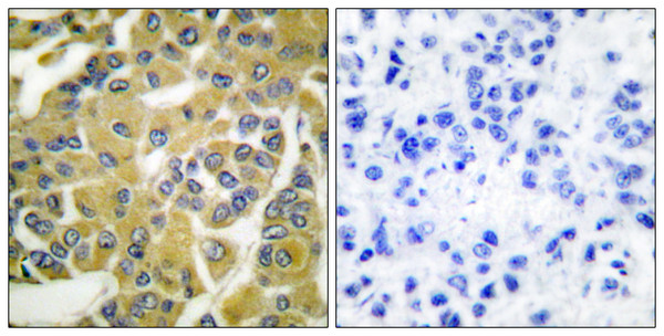Immunohistochemistry analysis of paraffin-embedded human breast carcinoma, using IKK-beta (Phospho-Tyr188) Antibody. The picture on the right is blocked with the phospho peptide.