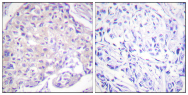 Immunohistochemistry analysis of paraffin-embedded human breast carcinoma, using PAK1 (Phospho-Thr212) Antibody. The picture on the right is blocked with the phospho peptide.