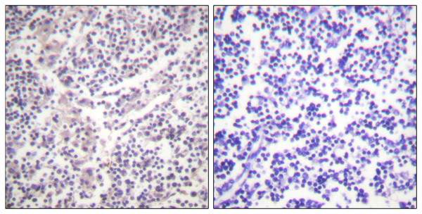 Immunohistochemistry analysis of paraffin-embedded human lymph node, using Caspase 3 (Phospho-Ser150) Antibody. The picture on the right is blocked with the phospho peptide.