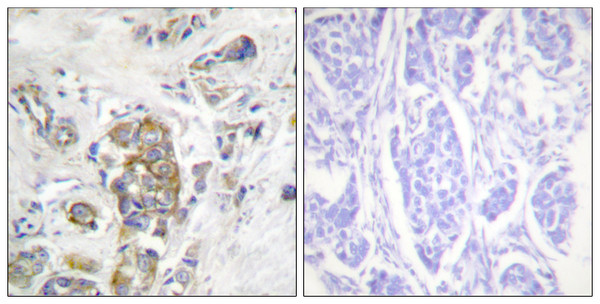 Immunohistochemistry analysis of paraffin-embedded human breast carcinoma, using ITGB4 (Phospho-Tyr1510) Antibody. The picture on the right is blocked with the phospho peptide.