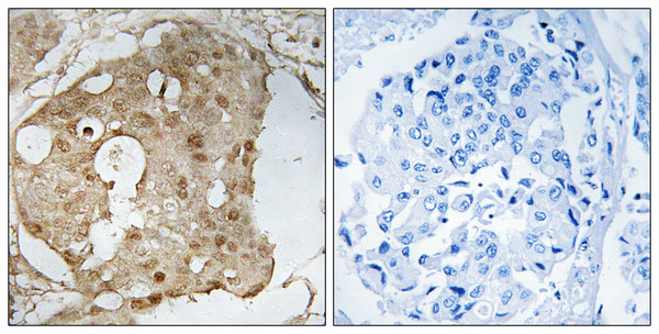 Immunohistochemistry analysis of paraffin-embedded human breast carcinoma, using p53 (Phospho-Ser366) Antibody. The picture on the right is blocked with the phospho peptide.