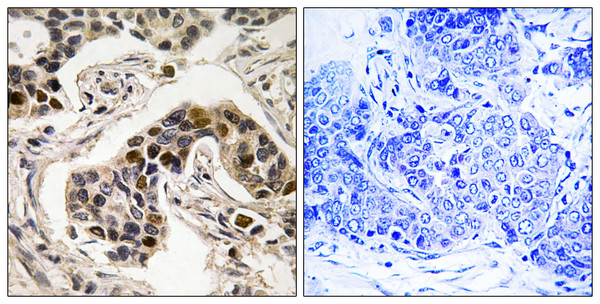 Immunohistochemistry analysis of paraffin-embedded human breast carcinoma, using NudC (Phospho-Ser326) Antibody. The picture on the right is blocked with the phospho peptide.