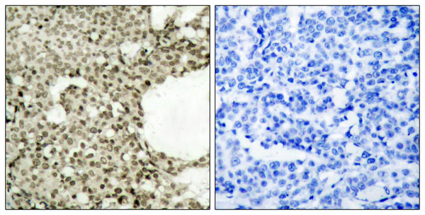 Immunohistochemistry analysis of paraffin-embedded human breast carcinoma, using STAT1 (Phospho-Ser727) Antibody. The picture on the right is blocked with the phospho peptide. Immunohistochemistry analysis of paraffin-embedded human breast carcinoma, using STAT1 (Phospho-Ser727) Antibody. The picture on the right is blocked with the phospho peptide.