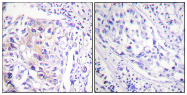 Immunohistochemistry analysis of paraffin-embedded human breast carcinoma, using CBL (Phospho-Tyr774) Antibody. The picture on the right is blocked with the phospho peptide. Immunohistochemistry analysis of paraffin-embedded human breast carcinoma, using CBL (Phospho-Tyr774) Antibody. The picture on the right is blocked with the phospho peptide.