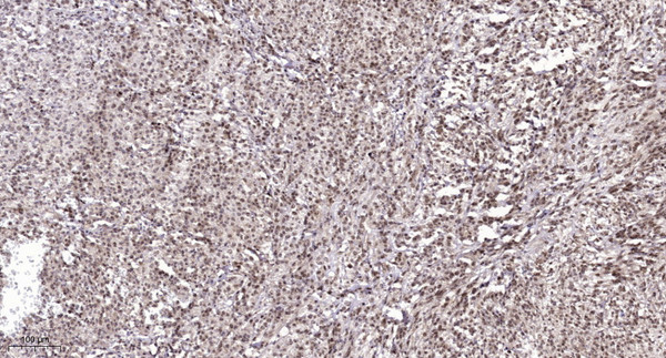Immunohistochemical analysis of paraffin-embedded human colon cancer. 1, Antibody was diluted at 1:200 (4°C overnight). STJ91326