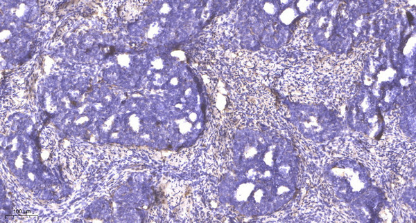 Immunohistochemical analysis of paraffin-embedded human cervical carcinoma. 1, Antibody was diluted at 1:200 (4°C STJ91344