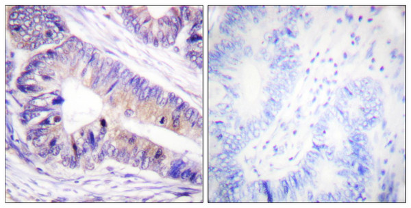 Immunohistochemistry analysis of paraffin-embedded human colon carcinoma tissue, using 14-3-3 zeta/delta Antibody. The picture on the right is blocked with the synthesized peptide.