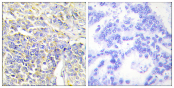 Immunohistochemistry analysis of paraffin-embedded human lung carcinoma tissue, using KAD1 Antibody. The picture on the right is blocked with the synthesized peptide.