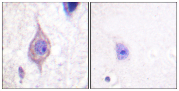 Immunohistochemistry analysis of paraffin-embedded human brain tissue, using ALK Antibody. The picture on the right is blocked with the synthesized peptide. Immunohistochemistry analysis of paraffin-embedded human brain tissue, using ALK Antibody. The picture on the right is blocked with the synthesized peptide.