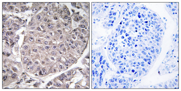 Immunohistochemistry analysis of paraffin-embedded human liver carcinoma tissue, using APOL4 Antibody. The picture on the right is blocked with the synthesized peptide.