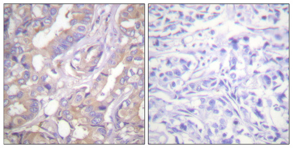 Immunohistochemistry analysis of paraffin-embedded human breast carcinoma tissue, using A-RAF Antibody. The picture on the right is blocked with the synthesized peptide. Immunohistochemistry analysis of paraffin-embedded human breast carcinoma tissue, using A-RAF Antibody. The picture on the right is blocked with the synthesized peptide.