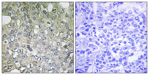 Immunohistochemistry analysis of paraffin-embedded human breast carcinoma tissue, using ADRA1D Antibody. The picture on the right is blocked with the synthesized peptide.