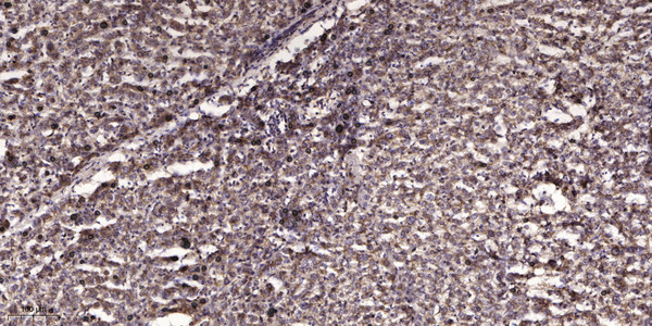 Immunohistochemical analysis of paraffin-embedded human liver cancer. 1, Antibody was diluted at 1:200 (4° overnight). STJ91748