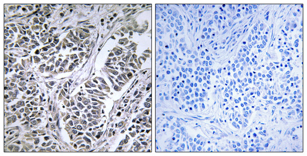 Immunohistochemistry analysis of paraffin-embedded human lung carcinoma tissue, using ATP5D Antibody. The picture on the right is blocked with the synthesized peptide.