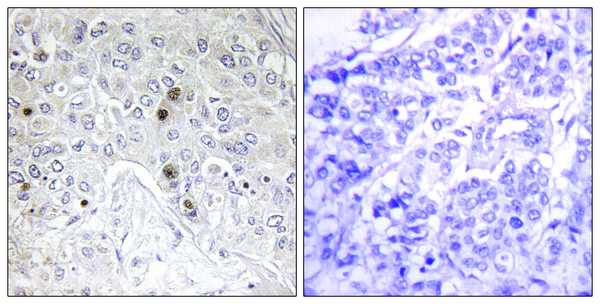 Immunohistochemistry analysis of paraffin-embedded human breast carcinoma tissue, using BATF Antibody. The picture on the right is blocked with the synthesized peptide.