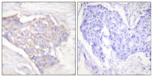 Immunohistochemistry analysis of paraffin-embedded human breast carcinoma tissue, using BIM Antibody. The picture on the right is blocked with the synthesized peptide.