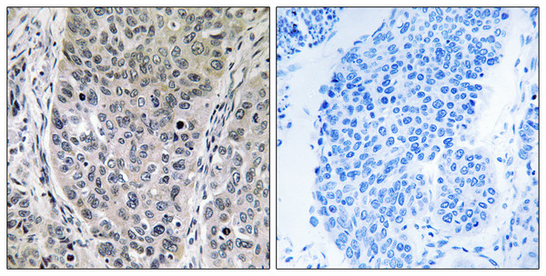 Immunohistochemistry analysis of paraffin-embedded human lung carcinoma tissue, using BRP16 Antibody. The picture on the right is blocked with the synthesized peptide. Immunohistochemistry analysis of paraffin-embedded human lung carcinoma tissue, using BRP16 Antibody. The picture on the right is blocked with the synthesized peptide.