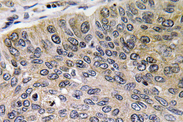 Immunohistochemistry analysis of Cathepsin?E antibody in paraffin-embedded human lung carcinoma tissue.