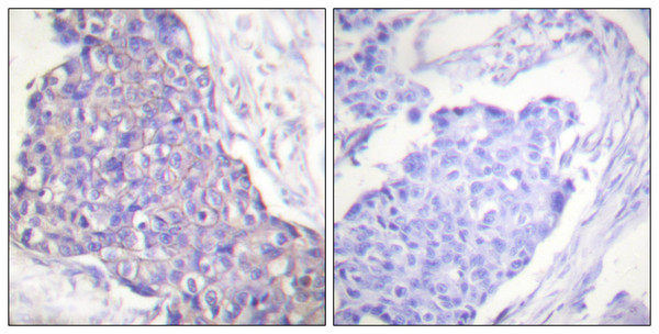 Immunohistochemistry analysis of paraffin-embedded human breast carcinoma tissue, using CD40 Antibody. The picture on the right is blocked with the synthesized peptide. Immunohistochemistry analysis of paraffin-embedded human breast carcinoma tissue, using CD40 Antibody. The picture on the right is blocked with the synthesized peptide.