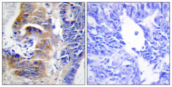 Immunohistochemistry analysis of paraffin-embedded human colon carcinoma tissue, using CDCA3 Antibody. The picture on the right is blocked with the synthesized peptide.