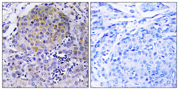 Immunohistochemistry analysis of paraffin-embedded human breast carcinoma tissue, using CEP78 Antibody. The picture on the right is blocked with the synthesized peptide.