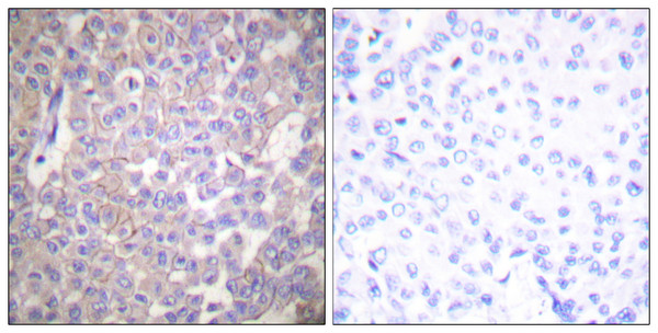 Immunohistochemistry analysis of paraffin-embedded human breast carcinoma tissue, using Claudin 2 Antibody. The picture on the right is blocked with the synthesized peptide.