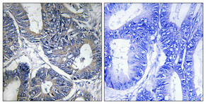 Immunohistochemical analysis of paraffin-embedded Human colon cancer. Antibody was diluted at 1:100 (4°C overnight). High-pressure and temperature Tris-EDTA, pH8.0 was used for antigen retrieval. Negetive contrl (right) obtaned from antibody was pre-absorbed by immunogen peptide.
