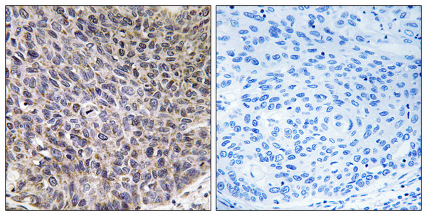 Immunohistochemistry analysis of paraffin-embedded human lung carcinoma tissue, using Cytochrome P450 4B1 Antibody. The picture on the right is blocked with the synthesized peptide.