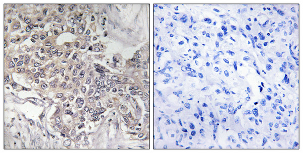 Immunohistochemistry analysis of paraffin-embedded human liver carcinoma tissue, using Cytochrome P450 4Z1 Antibody. The picture on the right is blocked with the synthesized peptide.