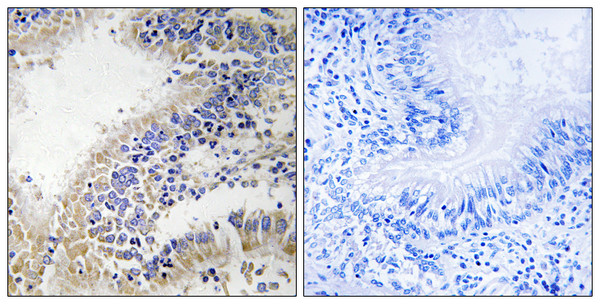 Immunohistochemistry analysis of paraffin-embedded human breast carcinoma tissue, using DHODH Antibody. The picture on the right is blocked with the synthesized peptide.