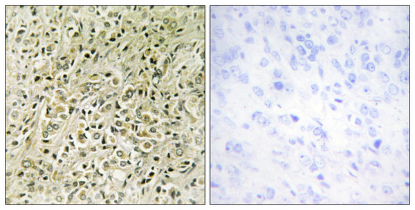 Immunohistochemistry analysis of paraffin-embedded human prostate carcinoma tissue, using RHG07 Antibody. The picture on the right is blocked with the synthesized peptide.