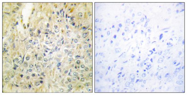 Immunohistochemistry analysis of paraffin-embedded human prostate carcinoma tissue, using DLEC1 Antibody. The picture on the right is blocked with the synthesized peptide.