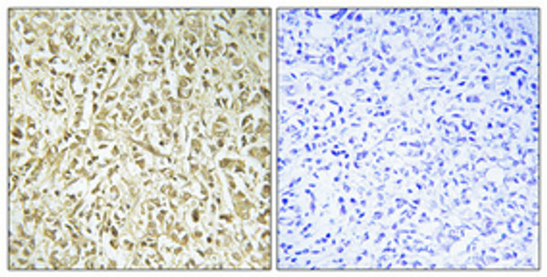 Immunohistochemical analysis of paraffin-embedded Human breast cancer. Antibody was diluted at 1:100 (4°C overnight). High-pressure and temperature Tris-EDTA, pH8.0 was used for antigen retrieval. Negetive contrl (right) obtaned from antibody was pre-absorbed by immunogen peptide. Immunohistochemical analysis of paraffin-embedded Human breast cancer. Antibody was diluted at 1:100 (4°C overnight). High-pressure and temperature Tris-EDTA, pH8.0 was used for antigen retrieval. Negetive contrl (right) obtaned from antibody was pre-absorbed by immunogen peptide.