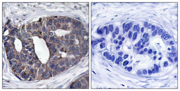 Immunohistochemistry analysis of paraffin-embedded human breast carcinoma tissue, using p62 Dok Antibody. The picture on the right is blocked with the synthesized peptide. Immunohistochemistry analysis of paraffin-embedded human breast carcinoma tissue, using p62 Dok Antibody. The picture on the right is blocked with the synthesized peptide.