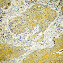Immunohistochemical analysis of paraffin-embedded Human breast cancer. Antibody was diluted at 1:100 (4°C overnight). High-pressure and temperature Tris-EDTA, pH8.0 was used for antigen retrieval.