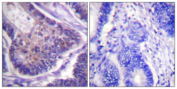 Immunohistochemistry analysis of paraffin-embedded human colon carcinoma tissue, using eIF4B Antibody. The picture on the right is blocked with the synthesized peptide.