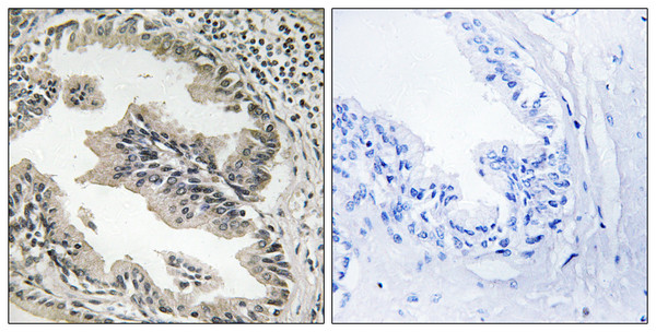 Immunohistochemistry analysis of paraffin-embedded human prostate carcinoma tissue, using SH3GLB2 Antibody. The picture on the right is blocked with the synthesized peptide.